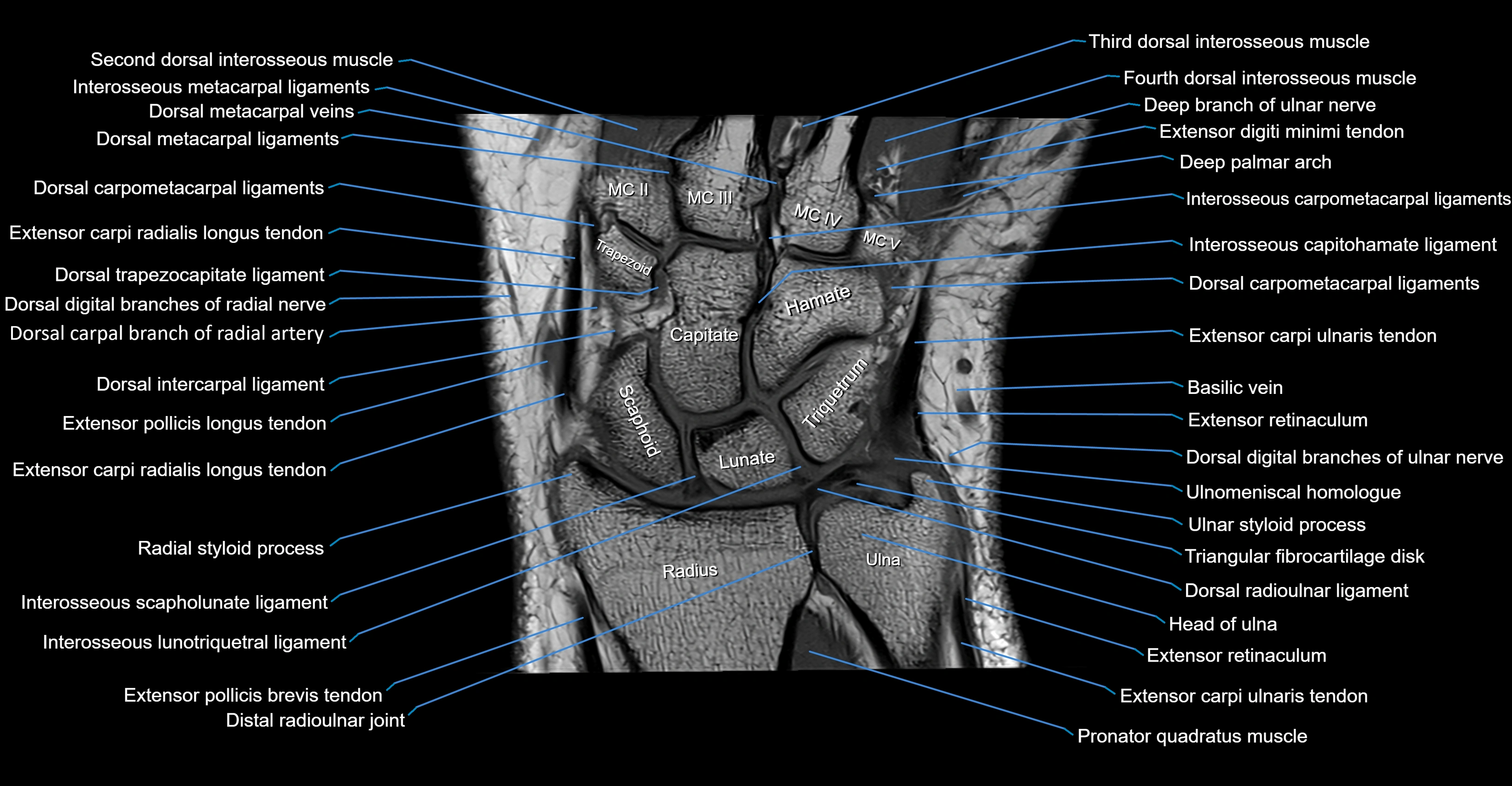 MRI wrist coronal cross sectional anatomy 3T  radiology  image-img-00001-00011.webp